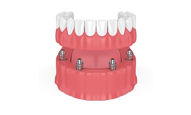 Zirconia Dentures Blanchard OK 73010